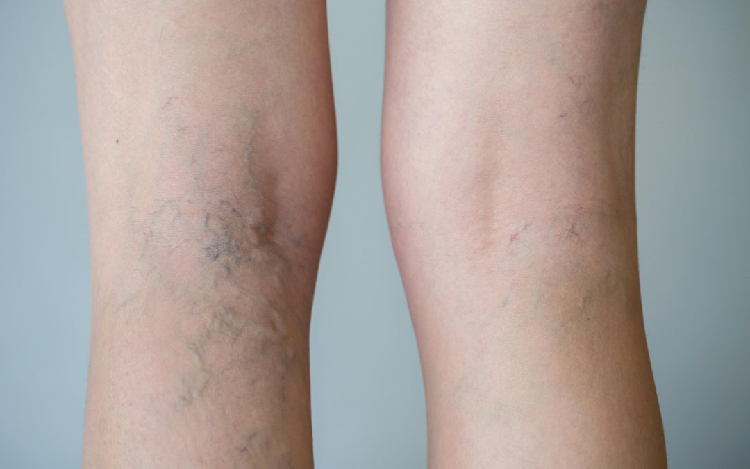 Enjoy Clearer Legs with Spider Veins Treatment in Richmond, VA, for Lasting Confidence